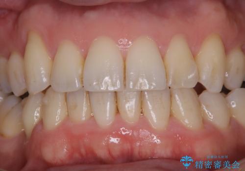 矯正治療終了時にクリーニングもの治療前