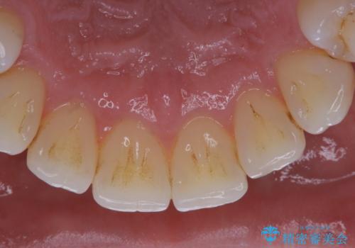 矯正治療終了時にクリーニングもの治療前