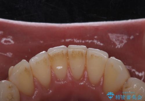 矯正治療終了時にクリーニングもの治療前