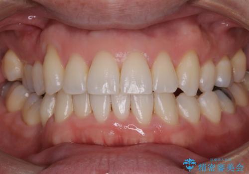 矯正治療終了時にクリーニングもの治療後