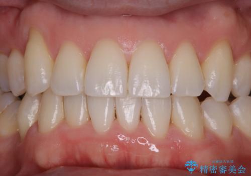 矯正治療終了時にクリーニングもの治療後