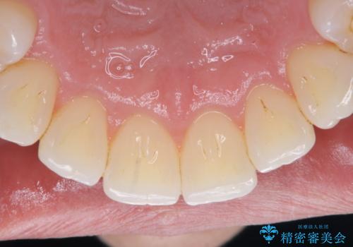 矯正治療終了時にクリーニングもの治療後