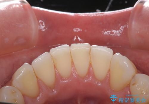 矯正治療終了時にクリーニングもの治療後