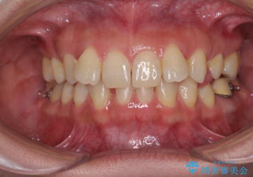 下顎2前歯の欠損　インビザラインによる抜歯矯正の治療中