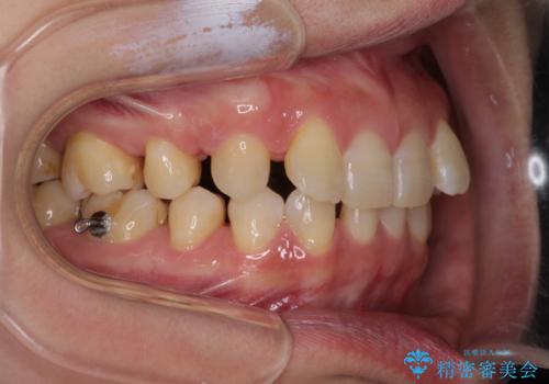 下顎2前歯の欠損　インビザラインによる抜歯矯正の治療中