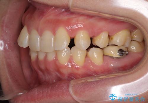 下顎2前歯の欠損 インビザラインによる抜歯矯正の治療中