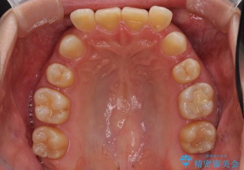 下顎2前歯の欠損 インビザラインによる抜歯矯正の治療中