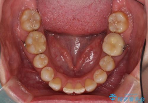 下顎2前歯の欠損 インビザラインによる抜歯矯正の治療中