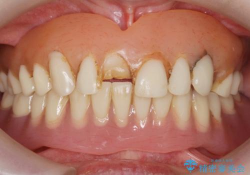 上の入れ歯がゆるくてはずれやすい　適合の良い金属床義歯　70代女性の症例 治療前