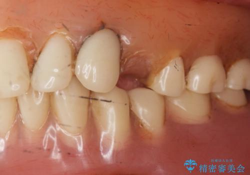 上の入れ歯がゆるくてはずれやすい　適合の良い金属床義歯　70代女性の治療前