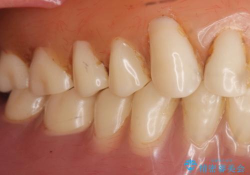 上の入れ歯がゆるくてはずれやすい　適合の良い金属床義歯　70代女性の治療前