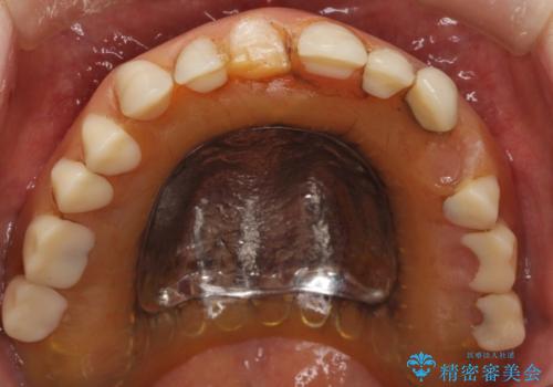 上の入れ歯がゆるくてはずれやすい 適合の良い金属床義歯 70代女性の治療前