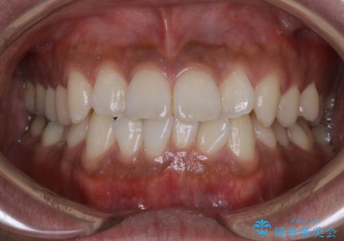 光加速矯正装置(オルソパルス)を用いた短期間での矯正治療