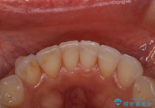 マウスピース矯正(インビザライン)中のPMTCの治療前