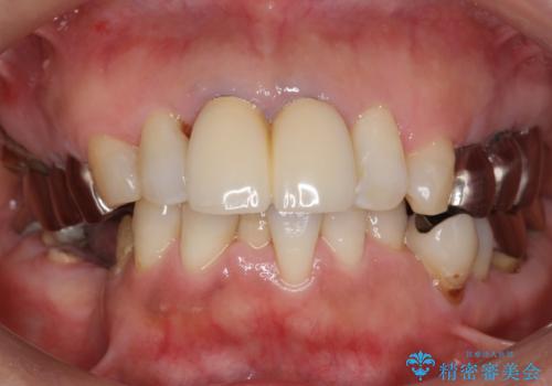 虫歯と歯並びを治したい 50代女性の治療前