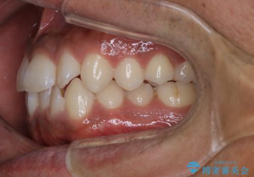 光加速矯正装置(オルソパルス)を用いた短期間での矯正治療の治療前