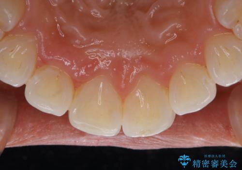 マウスピース矯正(インビザライン)中のPMTCの症例 治療後