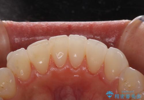 マウスピース矯正(インビザライン)中のPMTCの治療後