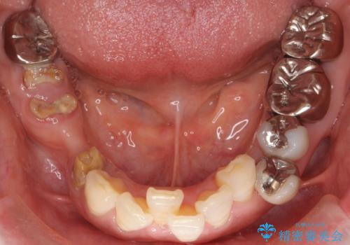 虫歯と歯並びを治したい 50代女性の治療前
