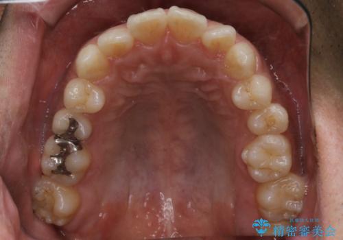 光加速矯正装置(オルソパルス)を用いた短期間での矯正治療の治療前