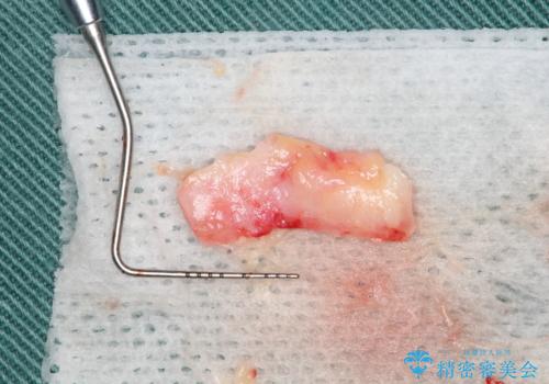 目立つ部位の歯茎がさがってきた　歯茎の移植で元の位置まで回復の治療中