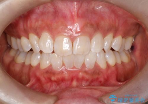 オフィスホワイトニング スペシャルコースの治療後