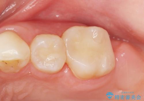 フロスを通すと臭い　歯と歯の間の虫歯　セラミックインレー　30代女性の症例 治療後