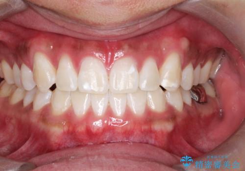 オフィスホワイトニング エクセレントコースの治療後