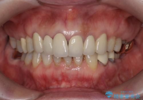 [ セラミック治療 ]前歯の見た目を改善したいの治療前