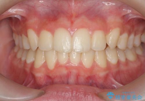 [ 前歯のガタつきを治す ]マウスピース矯正インビザラインの症例 治療後