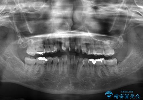目立たないハーフリンガル矯正 抜歯矯正で口元を改善の治療前