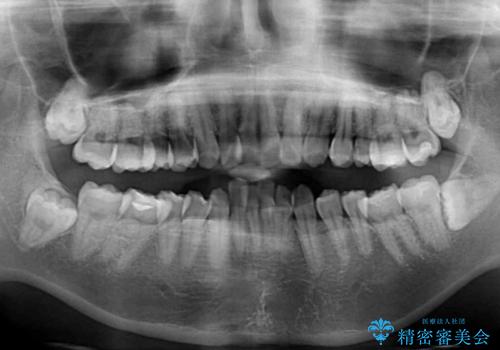 インビザラインが続けられない ワイヤー装置による抜歯矯正の治療前