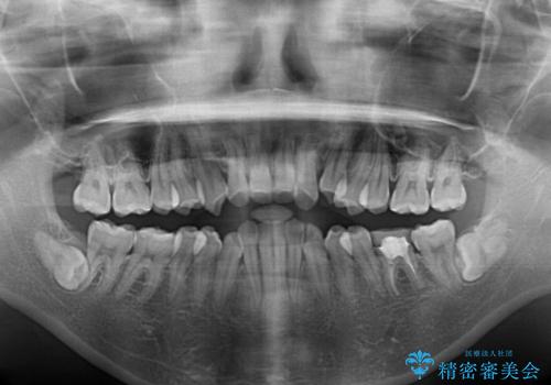 抜歯矯正で閉じにくかった口を閉じやすく改善の治療前