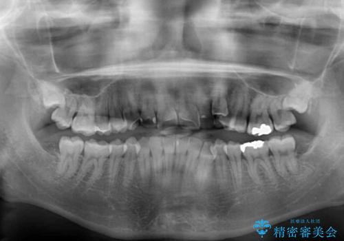 顕著な八重歯をインビザラインで治せるところまで改善の治療前