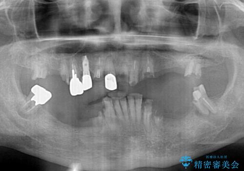 どこで咬んでいいのか分からない インプラント・オーバーデンチャーによる補綴治療の治療前
