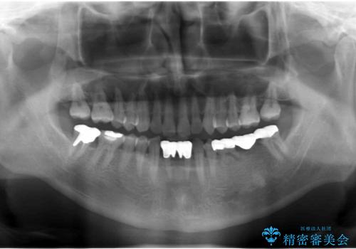 奥歯のインプラント 大人になって残っていた乳歯がダメになったの治療前