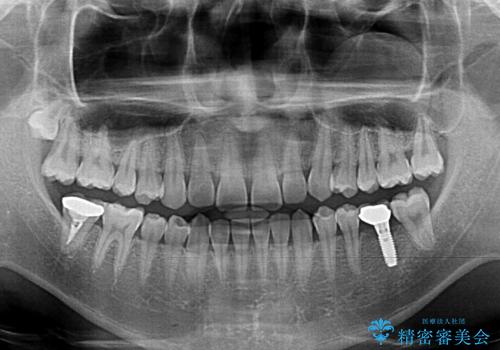 隙間の空いた前歯を治したい　上顎の部分矯正の治療前