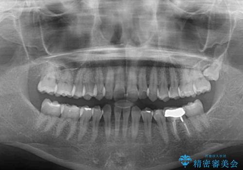 下顎2前歯の欠損 インビザラインによる抜歯矯正の治療前