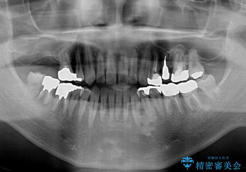前歯の反対咬合をワイヤー矯正で改善して噛みやすくの治療前
