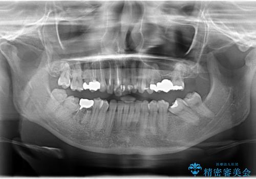 歯並びの改善とインプラントでのかみ合わせの回復　インプラント・セラミック・矯正全顎治療の治療前
