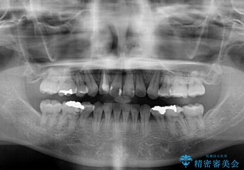 目立たないハーフリンガル矯正 抜歯矯正で口元を改善の治療後