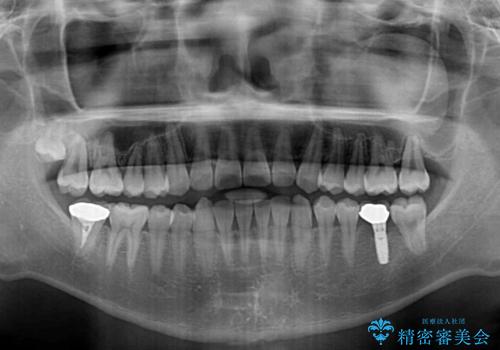 隙間の空いた前歯を治したい　上顎の部分矯正の治療後