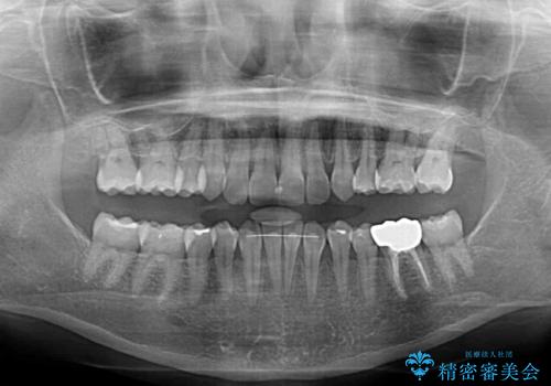 下顎2前歯の欠損 インビザラインによる抜歯矯正の治療後