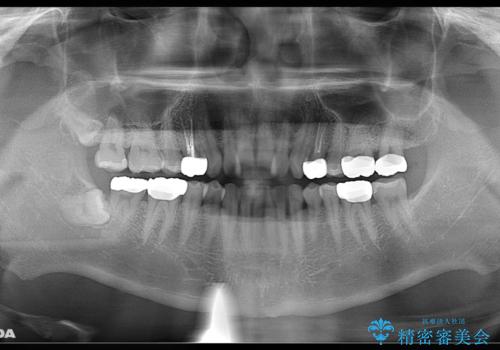 銀歯を無くしたい:適合の良いセラミックでやり替えの治療後