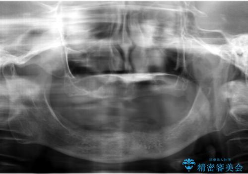 上の入れ歯がゆるくてはずれやすい 適合の良い金属床義歯 70代女性の治療前