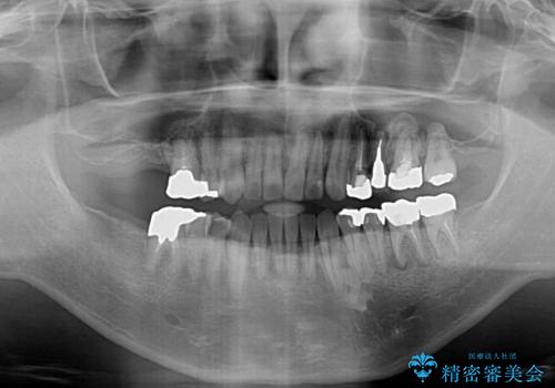 前歯の反対咬合をワイヤー矯正で改善して噛みやすくの治療後