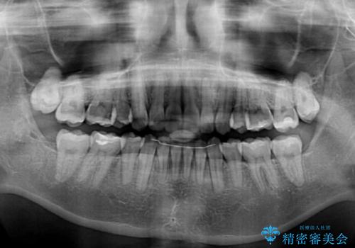 インビザラインが続けられない ワイヤー装置による抜歯矯正の治療後