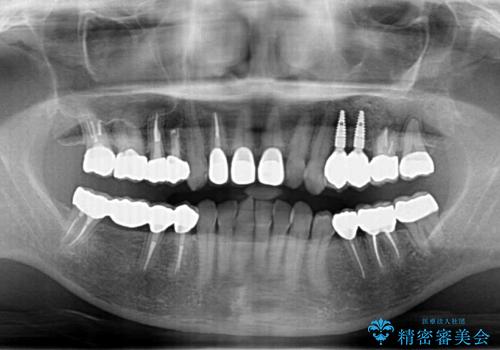 [ セラミック・インプラント全顎治療 ]  長年悩まされている歯の治療にケリをつけたい