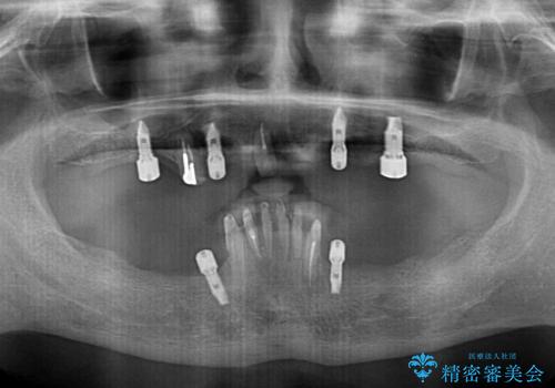 どこで咬んでいいのか分からない インプラント・オーバーデンチャーによる補綴治療の治療中