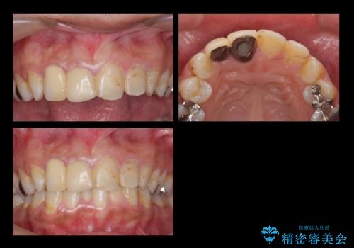 前歯の虫歯　つぎはぎの歯をセラミックにの治療前